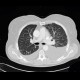Pulmonary carcinosis: CT - Computed tomography